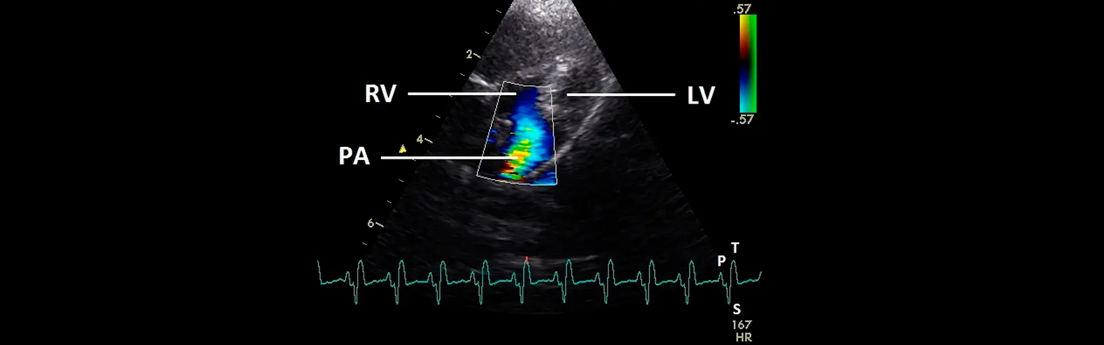 What is the Role of Color Doppler for Heart Issues?